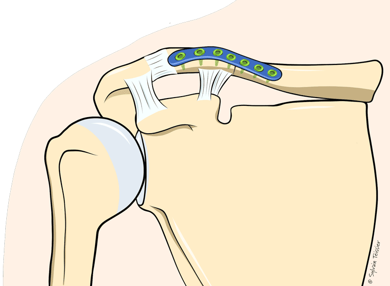 Fracture de la clavicule